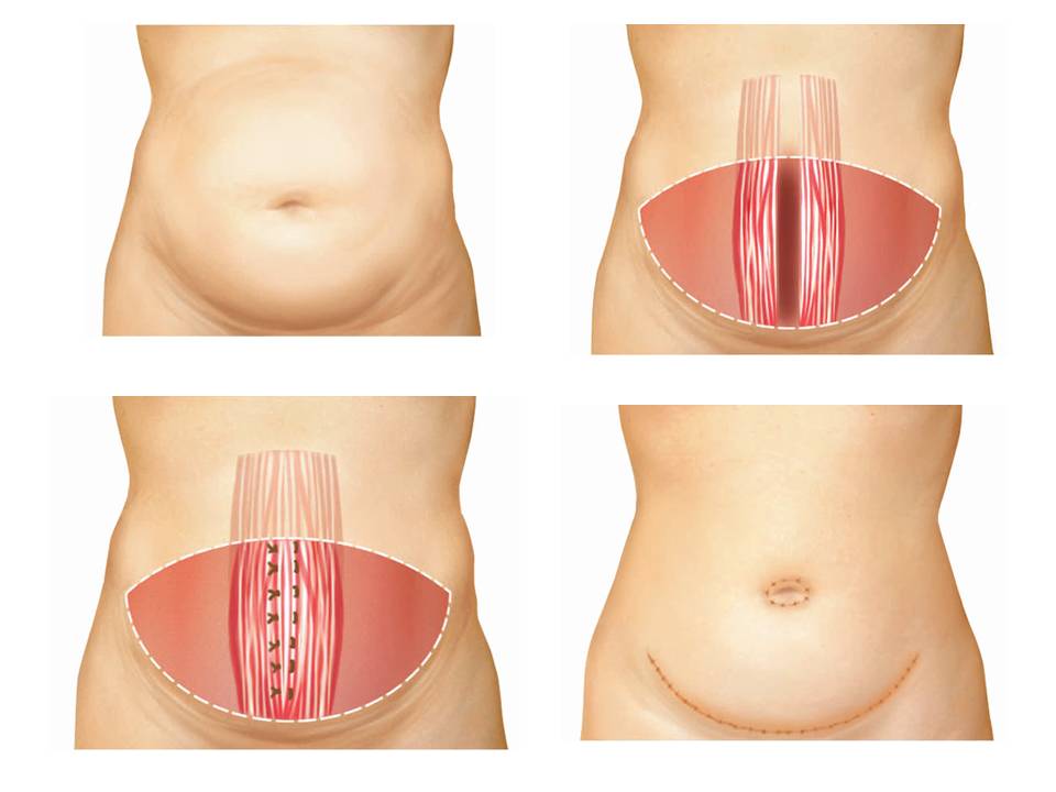 Abdominoplastia Diagrama