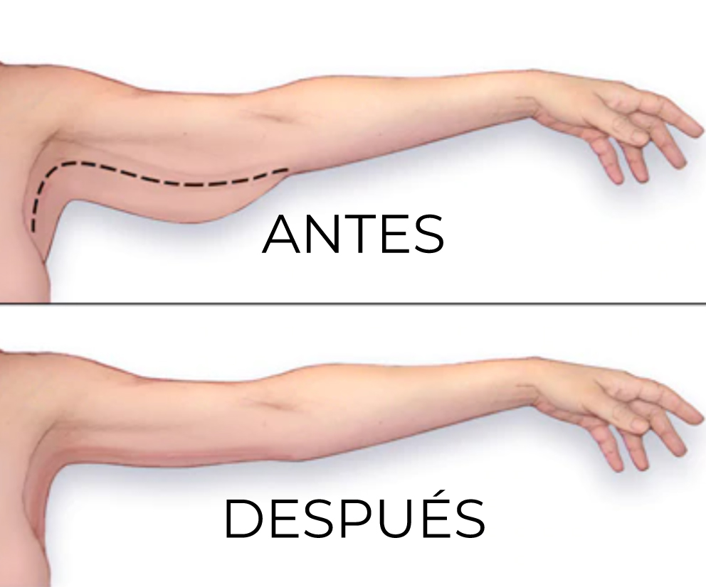 braquioplastia diagrama