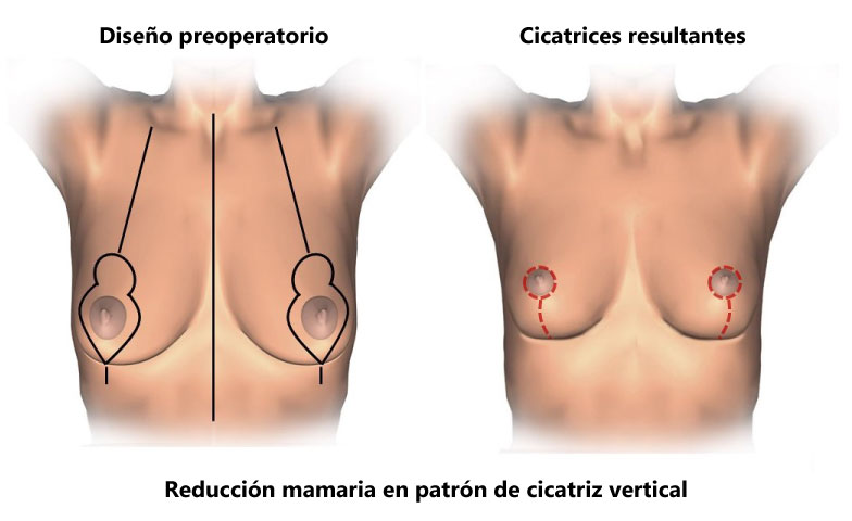 Reducción de Mamas