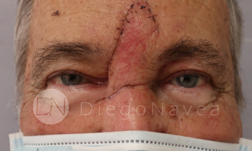 Antes y Después Tumor Facial