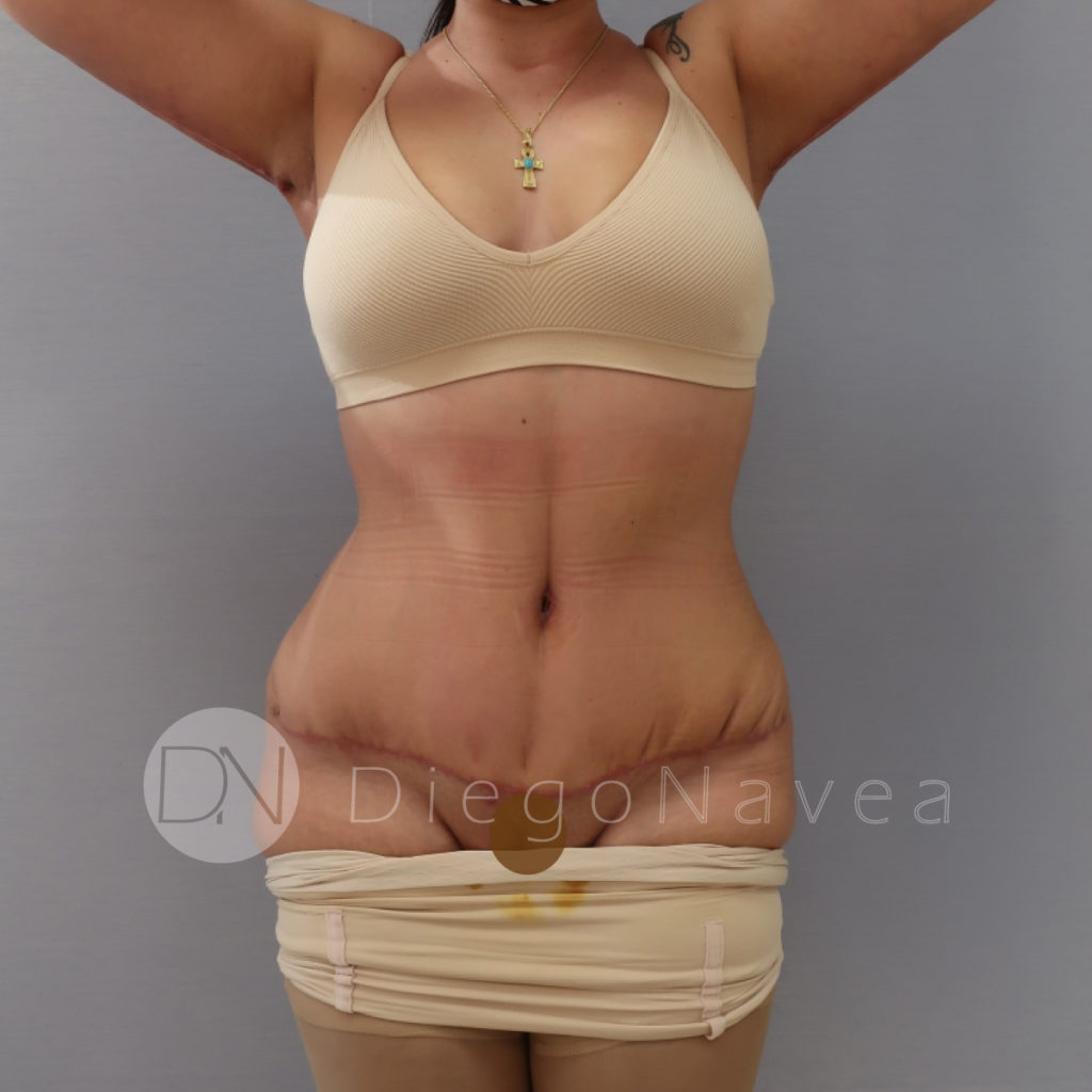 Abdominoplastia y Lipoescultura